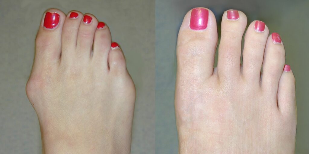Before and After Bunion Surgery