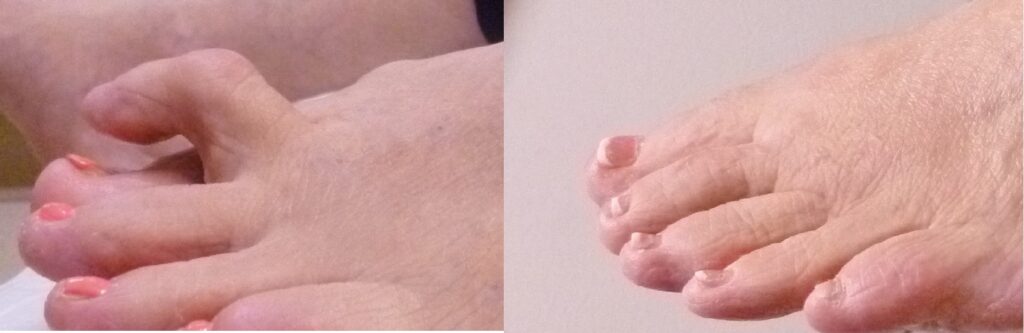 Before and After Hammertoe Surgery