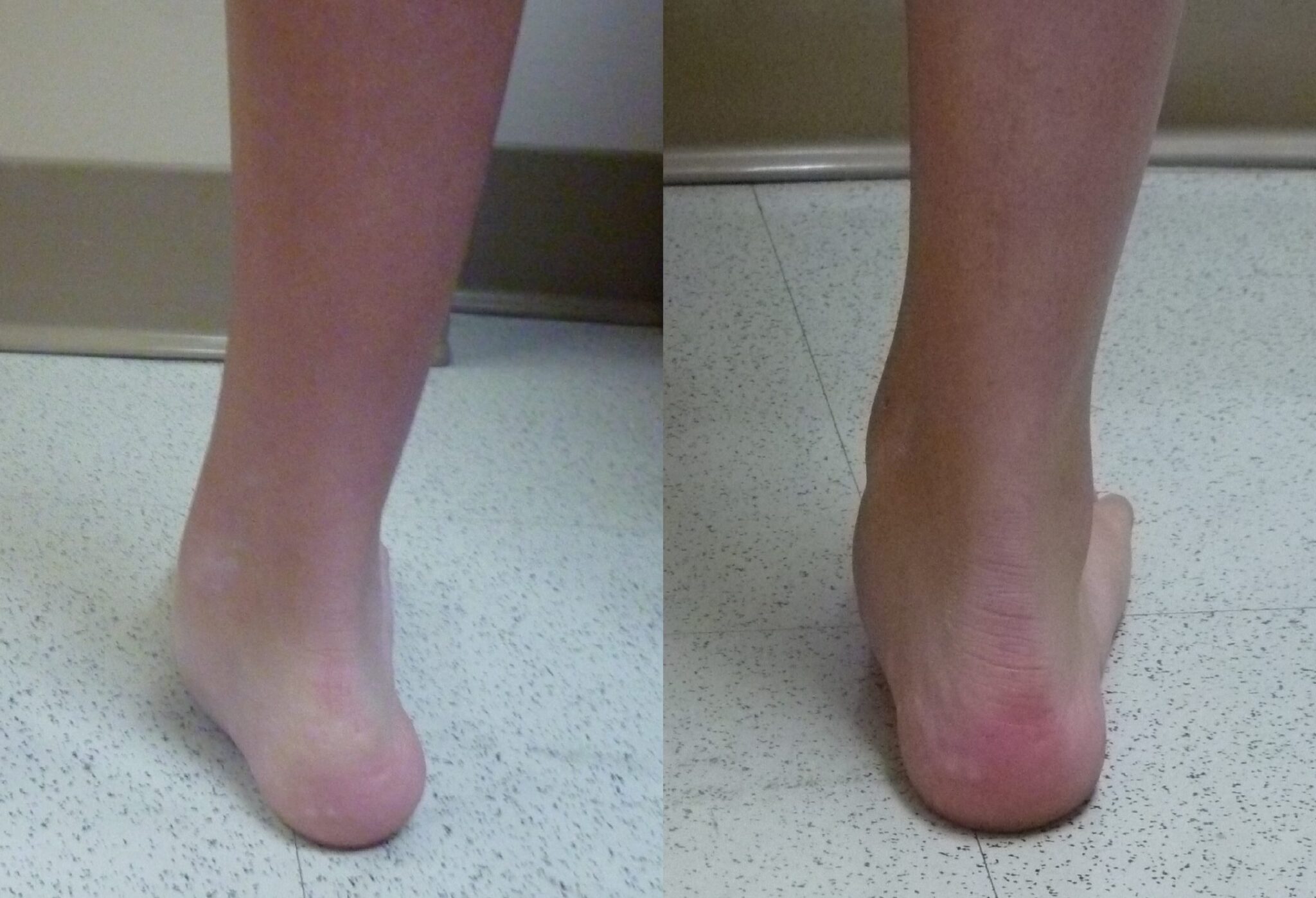 Before and After Surgeries | Artisan Foot and Ankle Specialists