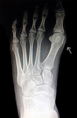 Osteotomy Bunionectomy before
