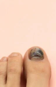 CUTTING PAINFUL SUPER THICK TOENAILS THAT SHE HID FROM HER FAMILY