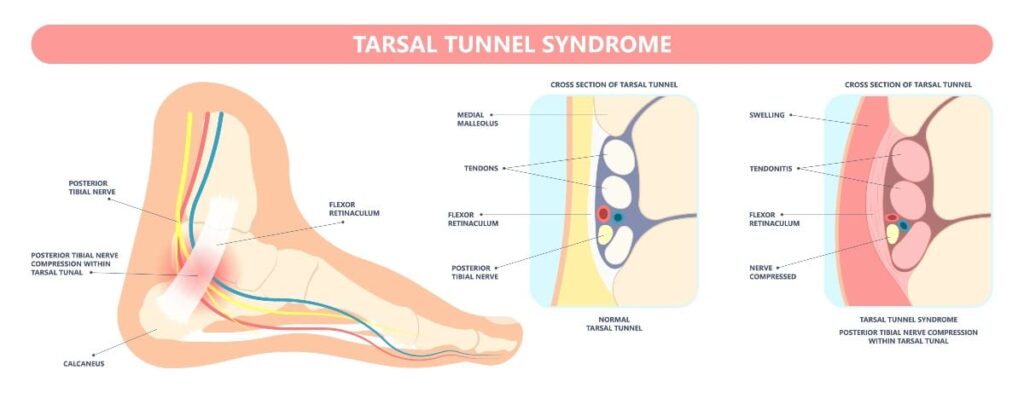 What is the Tarsal Tunnel?