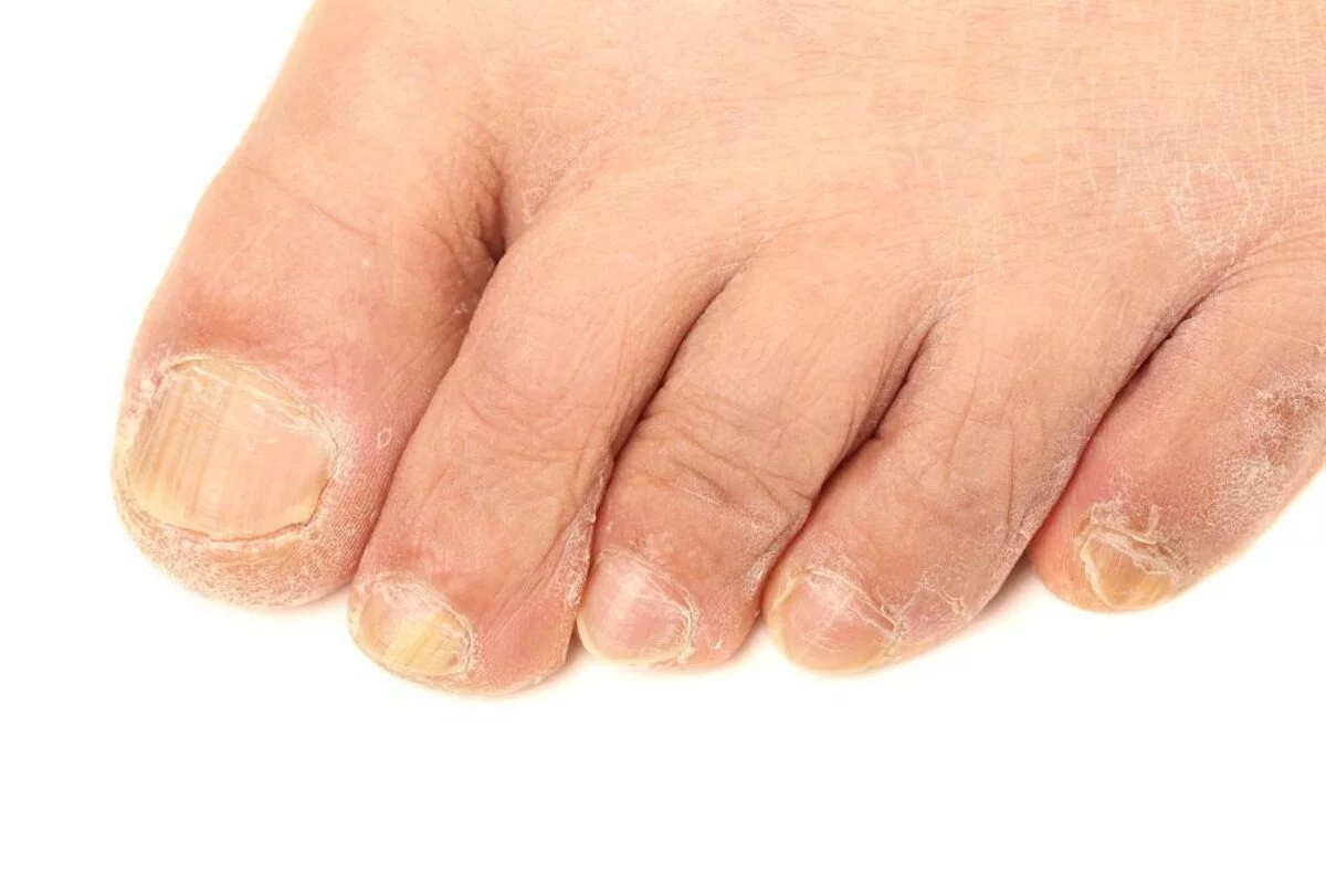 Understanding the Different Fungal Nail Infections and Best Treatment  Options
