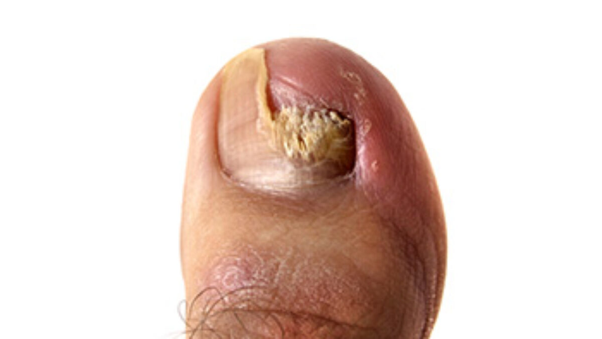 Skin and Toenail Conditions   Precision Foot and Ankle Centers