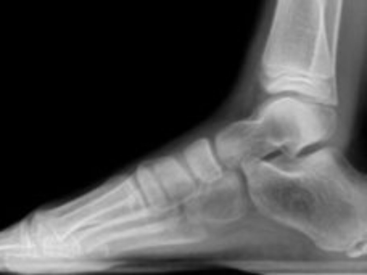 Bone fracture treatment & recovery time | TRIA Orthopedics