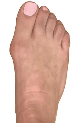 Lapidus Forever Bunionectomy™ Before image