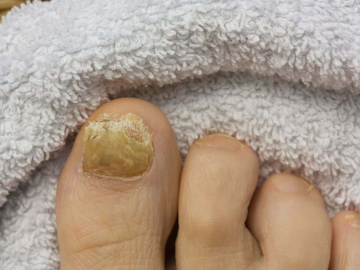 Incomplete development of the nail of the hallux in the newborn