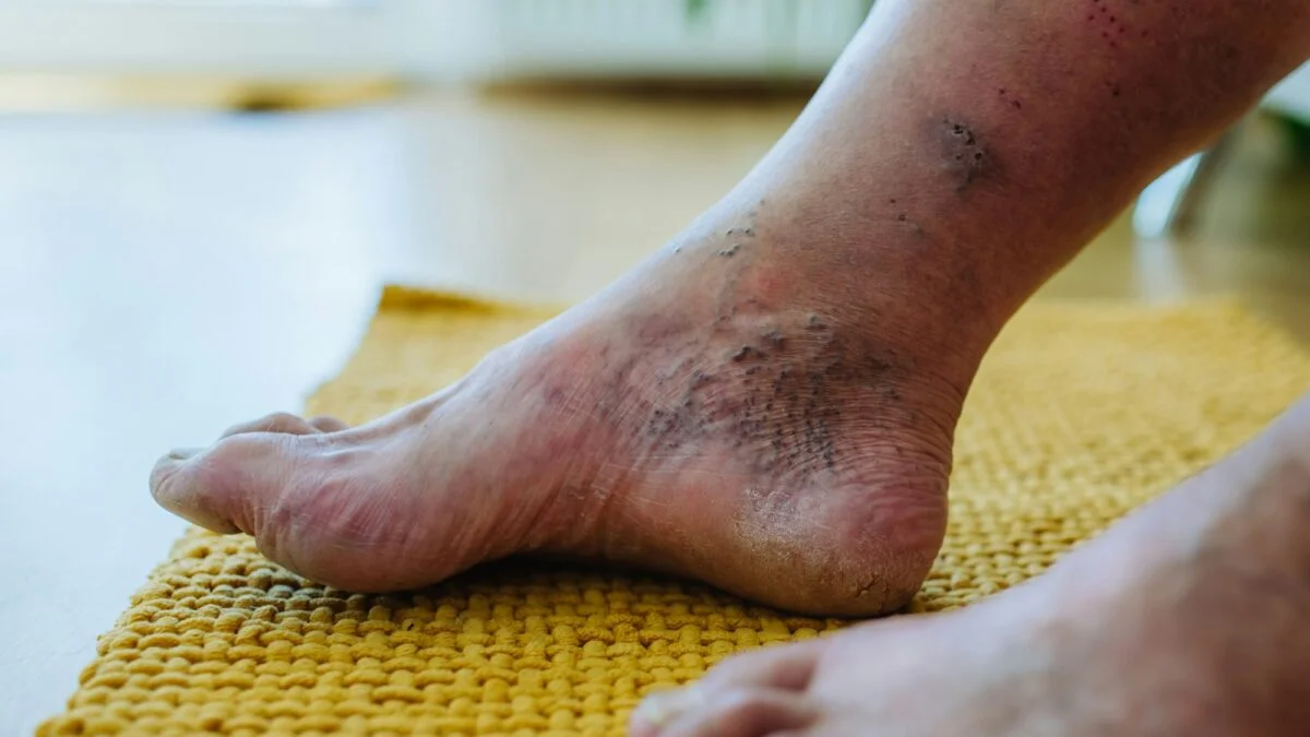injections of b12 into feet with peripheral neuropathy Foot and Nerve Pain Support Vitamin IV Therapy for Neuropathy: ALA