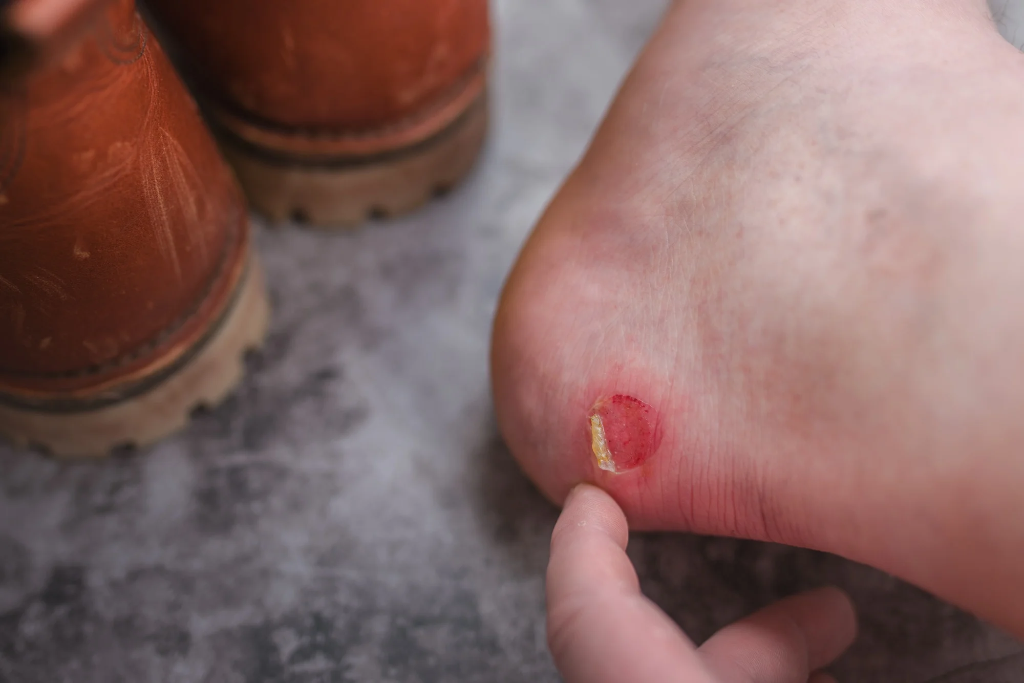 A rubbed blister on the heel of the foot.