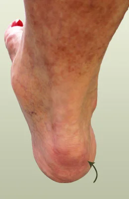 Achilles Spur Surgery before
