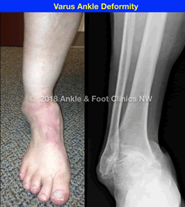 Ankle Deformity