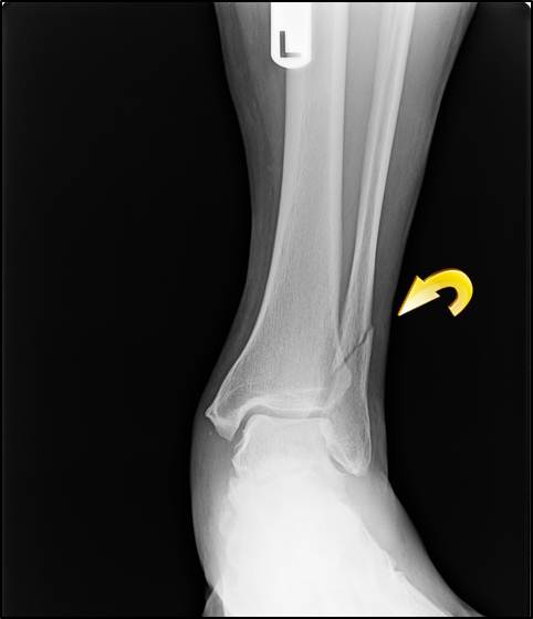 Ankle Fractures  Integrative Foot & Ankle Centers of Washington