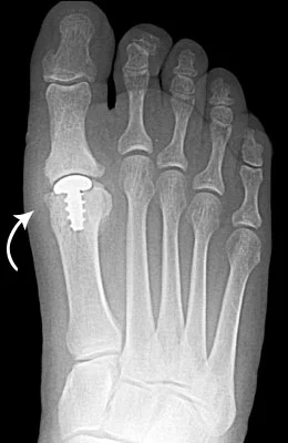 Arthrosurface Implant after