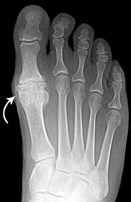 Arthrosurface Implant before