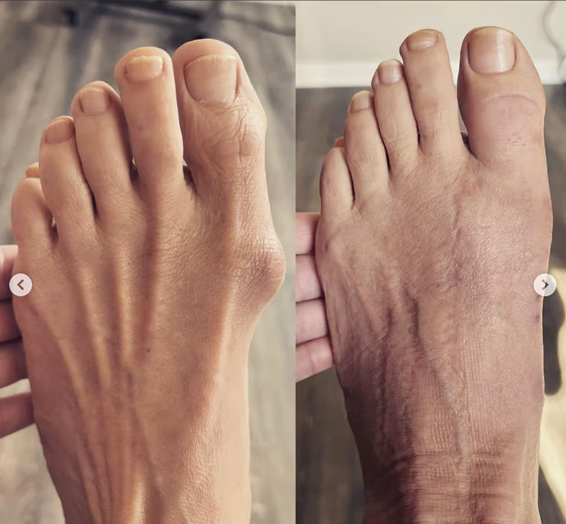 Before and after Bunion treatment