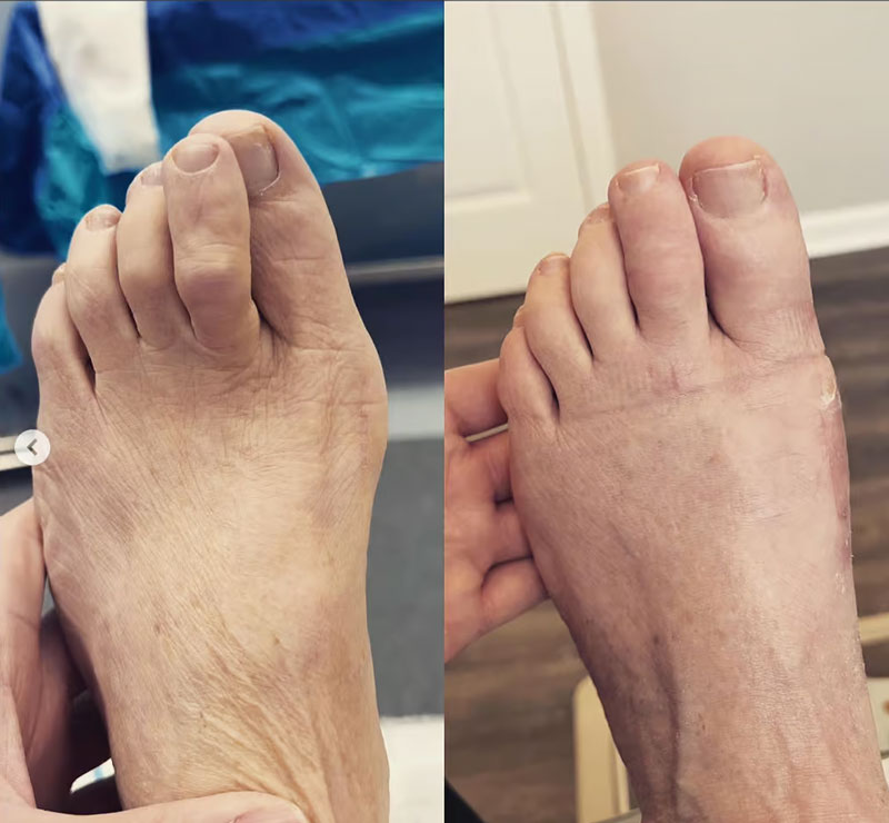 before and after hammertoe treatment