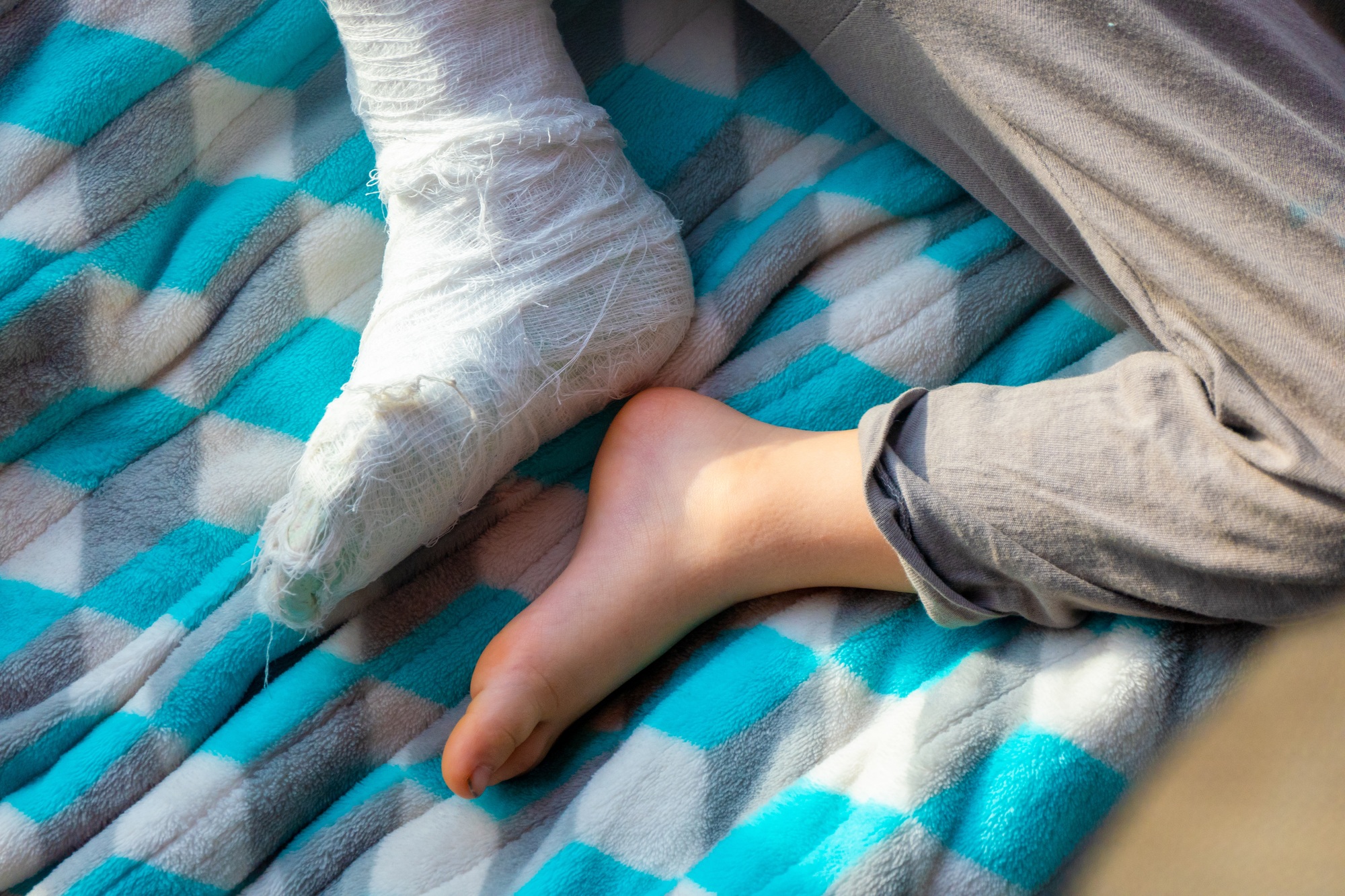 Calcaneal Apophysitis - Sever’s Disease