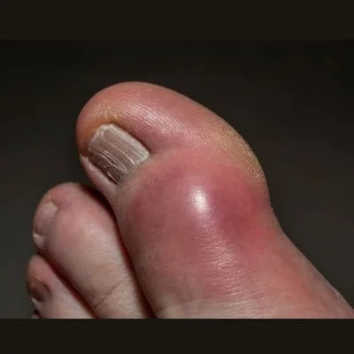 What are Chilblains?