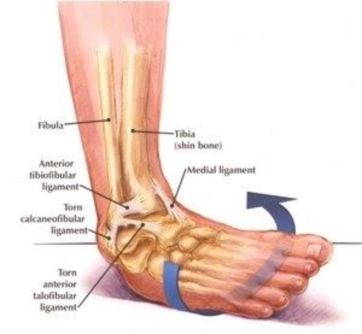 Chronic Ankle Instability  Artisan Foot and Ankle Specialists