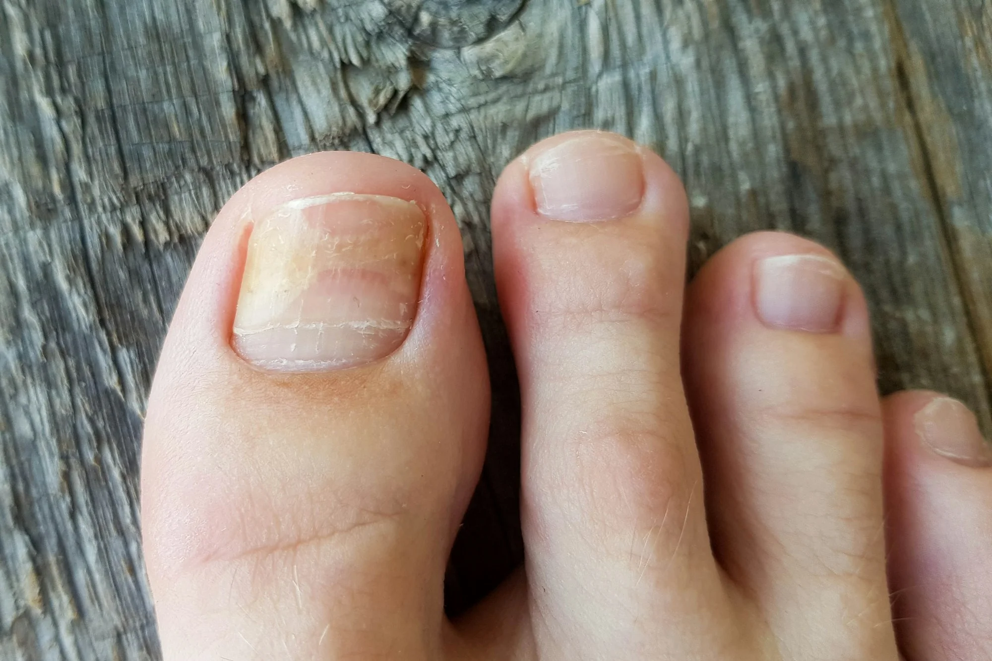 fungus on toenails