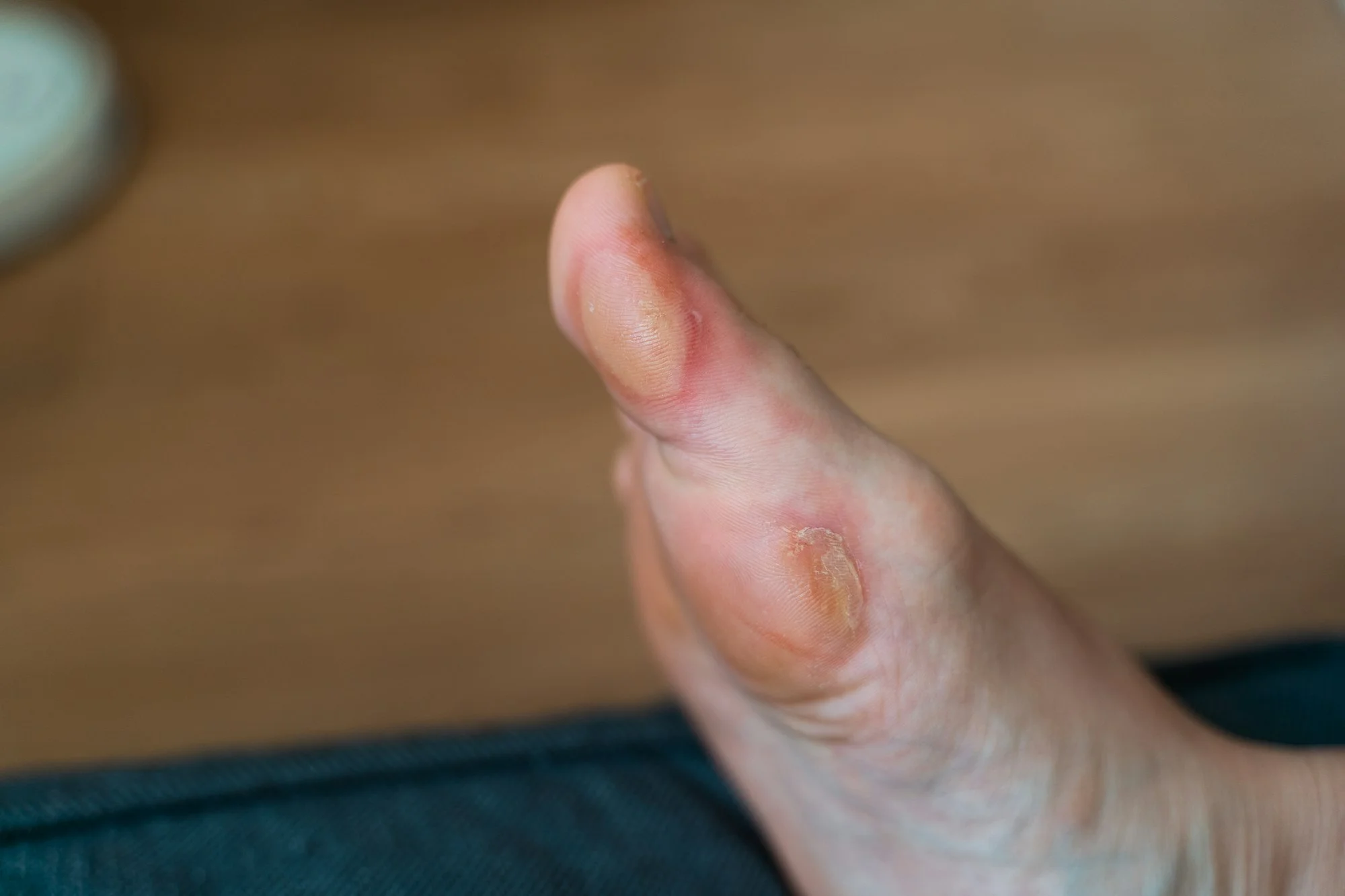 Close-up of a soft callus on a foot of a woman, sport shoes problem, corn on the leg. blister on the