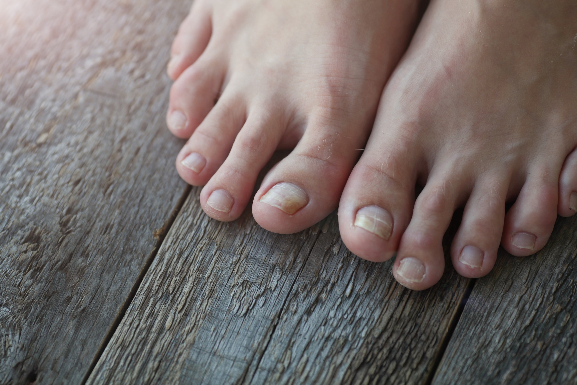 Laser Toenail Fungus