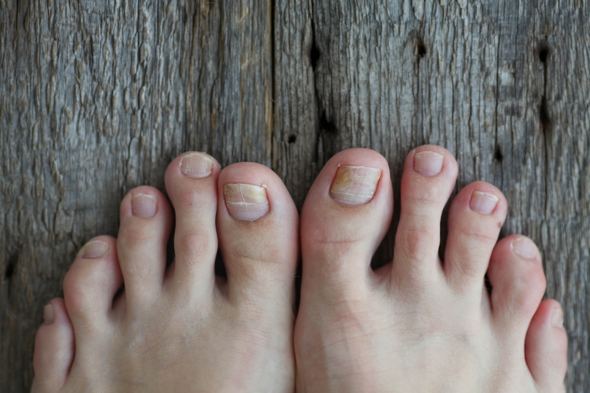 Understanding Fungal Nail Infections and Best Treatment Options