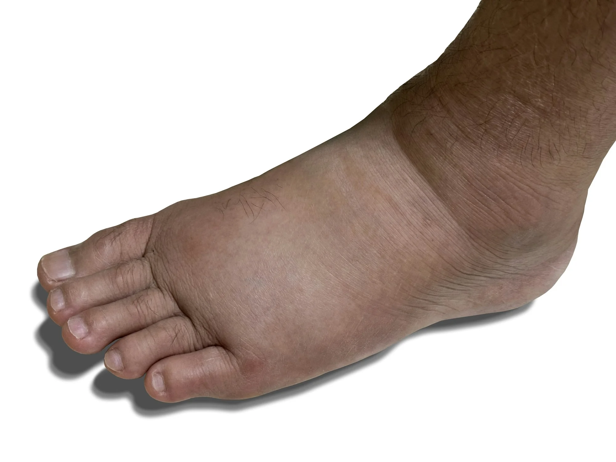 Close-up Swollen Foot