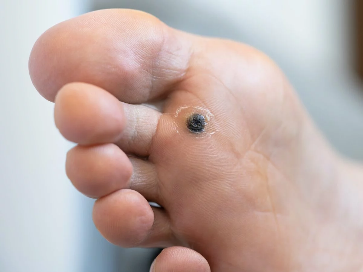 Flat Wart (HPV): Causes, Symptoms, and Treatment