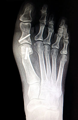 Austin Bunionectomy with Akin Procedure after