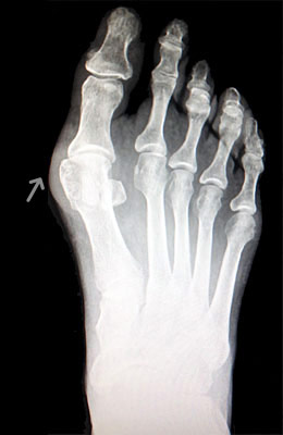 Austin Bunionectomy with Akin Procedure before