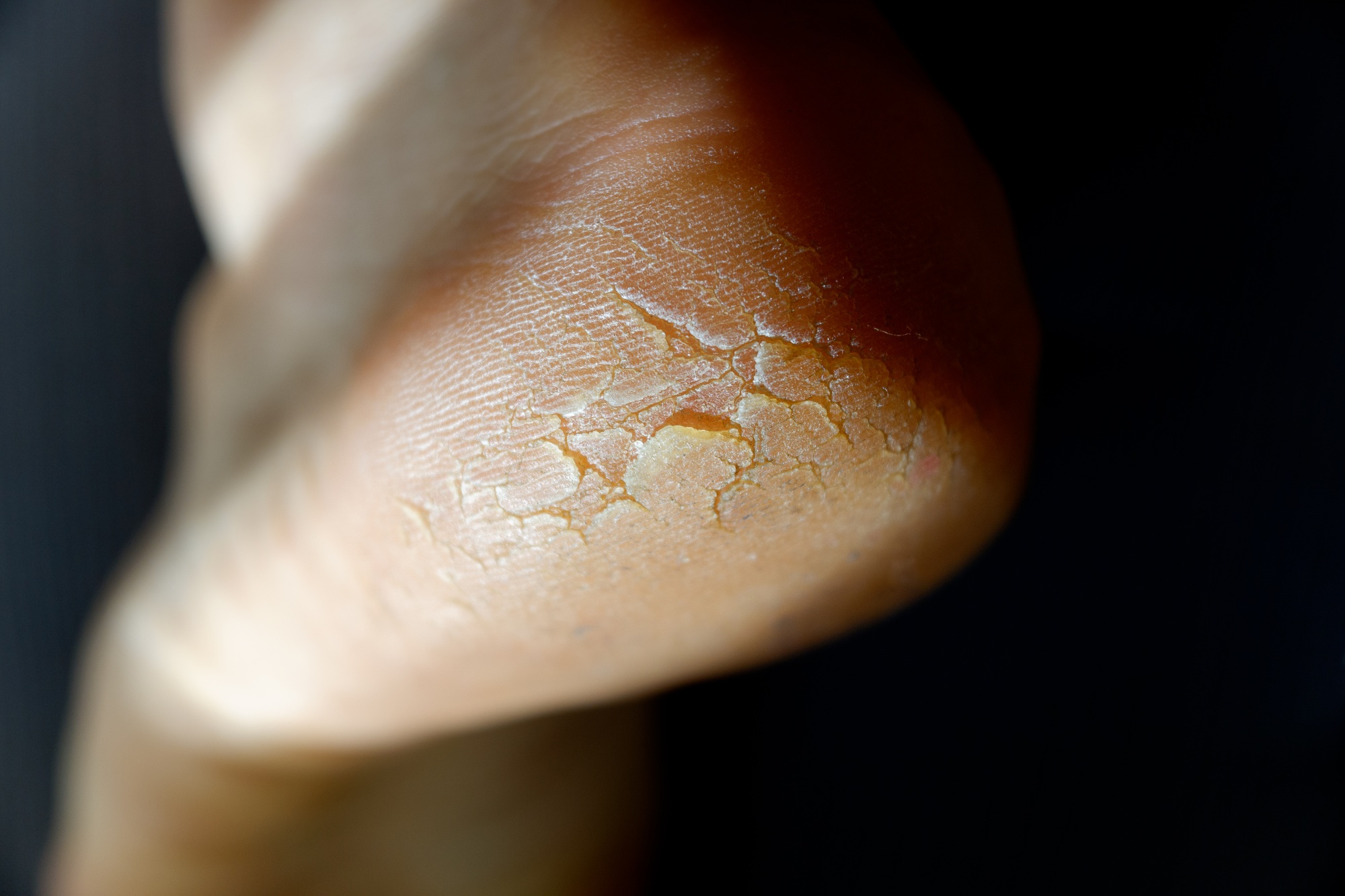 Cracked and dry heel of the foot skin.