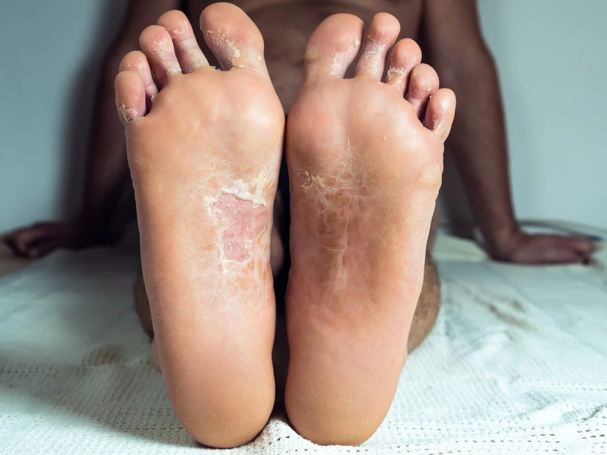 Red Spots on Feet: Athlete's Foot, Psoriasis, Other Causes
