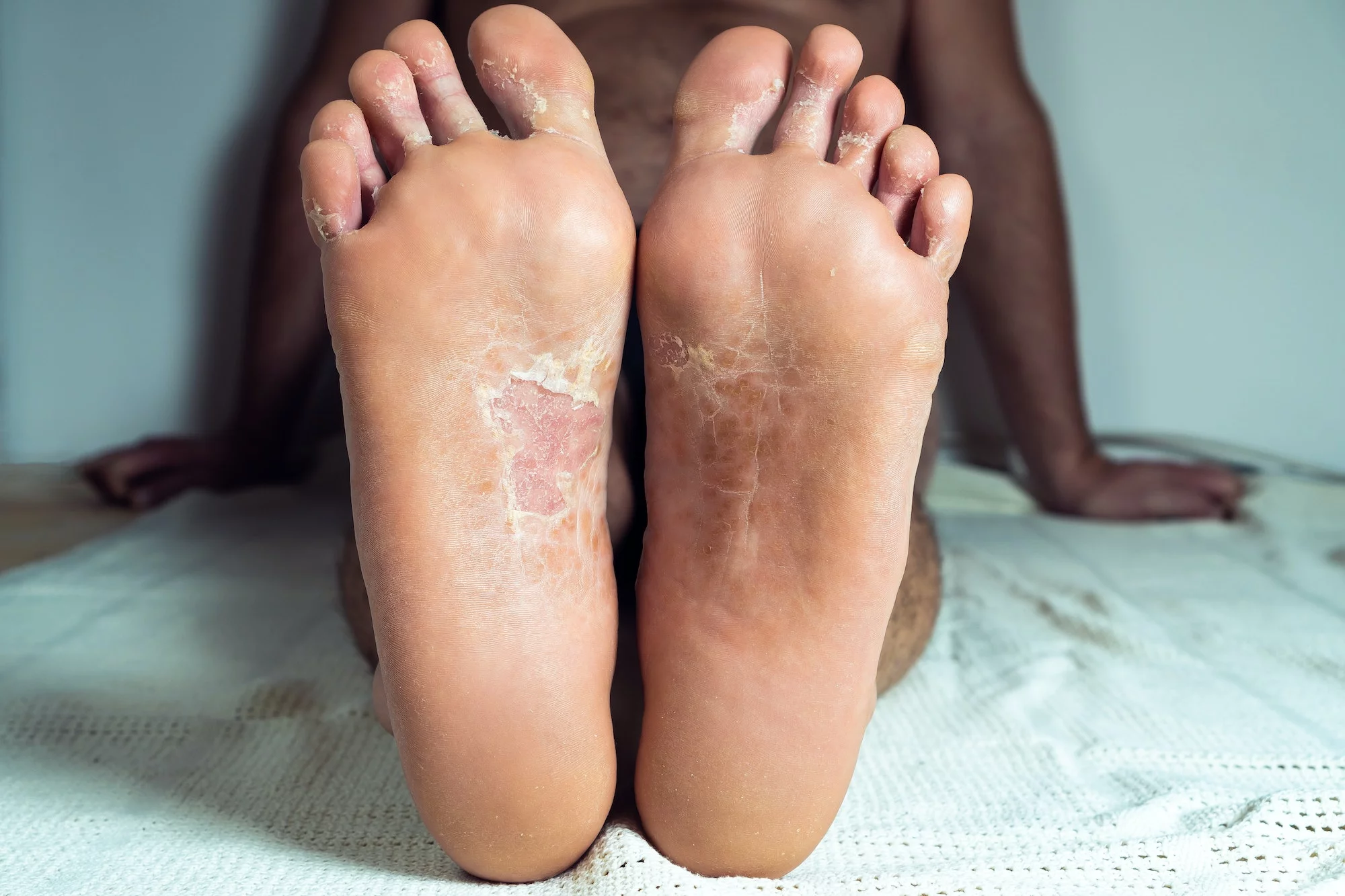 Why You Should Be Checking Your Soles and Palms If You Have a Dark  Complexion
