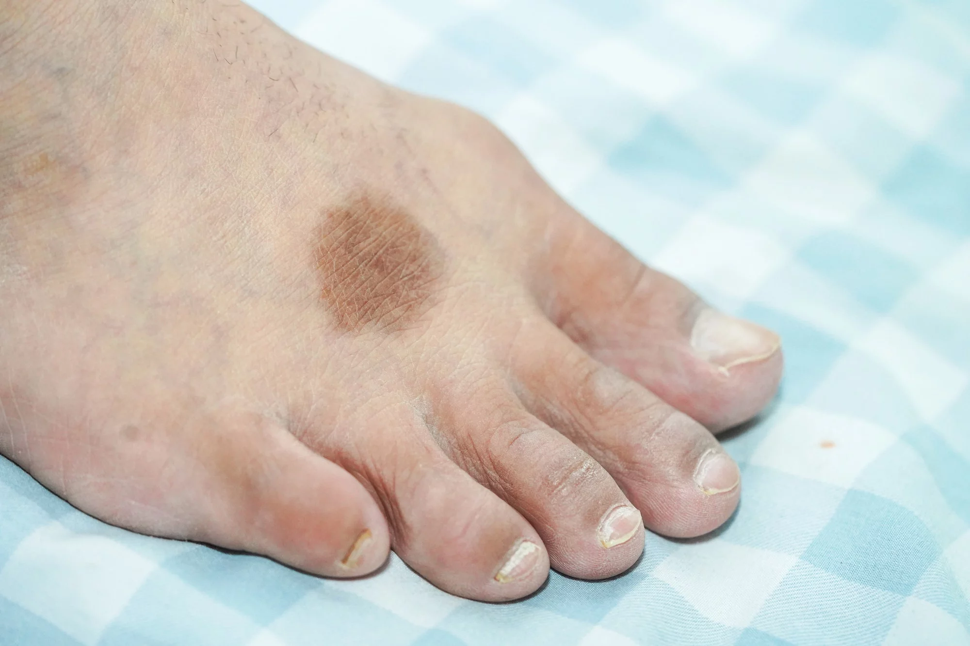 identifying-and-treating-rare-foot-conditions