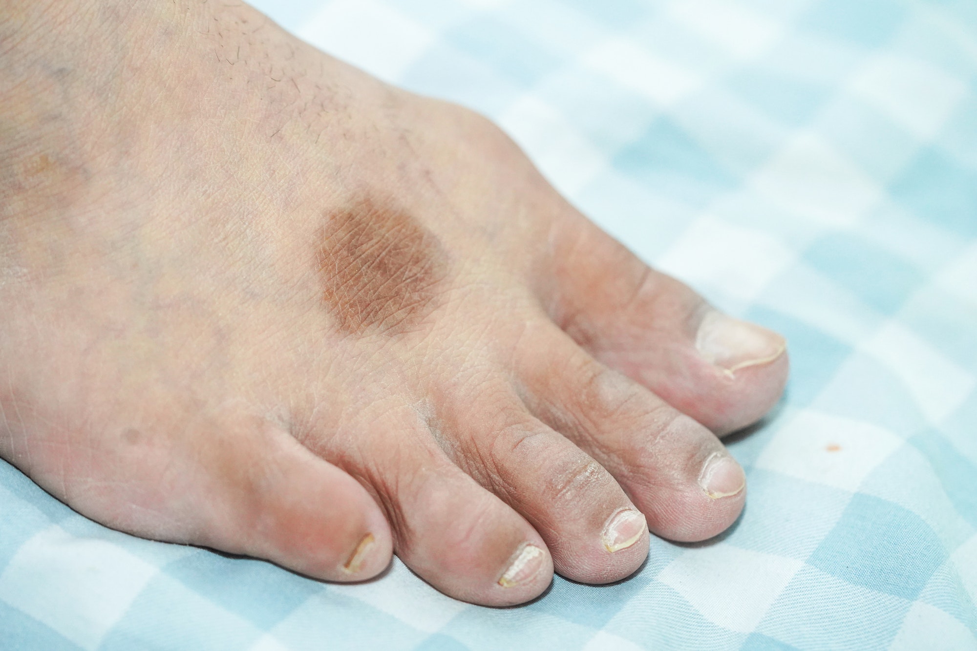 Complex Dermatology Integrative Foot Ankle Centers Of Washington