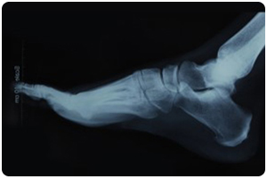Digital radiology has revolutionized podiatry care over the past decade. Digital x-rays allow our Suffolk, VA, podiatrists and our Hampton, VA, podiatrists at 1Foot 2Foot to take and magnify an image of your foot with crystal clear details. This enables our podiatrists to tell stress fractures apart from other abnormalities. It ensures a proper diagnosis of painful foot and ankle conditions with the ability to view the digital x-rays immediately in our podiatry office. We also use digital x-rays to monitor your foot’s structure on an ongoing basis in order to evaluate and treat any chronic foot conditions.