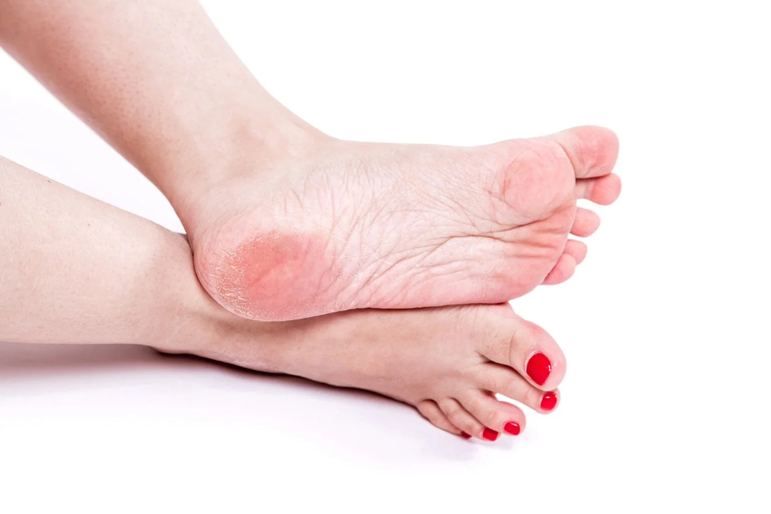 Skin Callules Corns and Calluses | Artisan Foot and Ankle Specialists