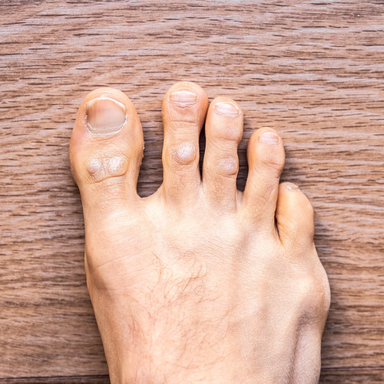 Crystal Toe Crystal Skin Toe Fungus