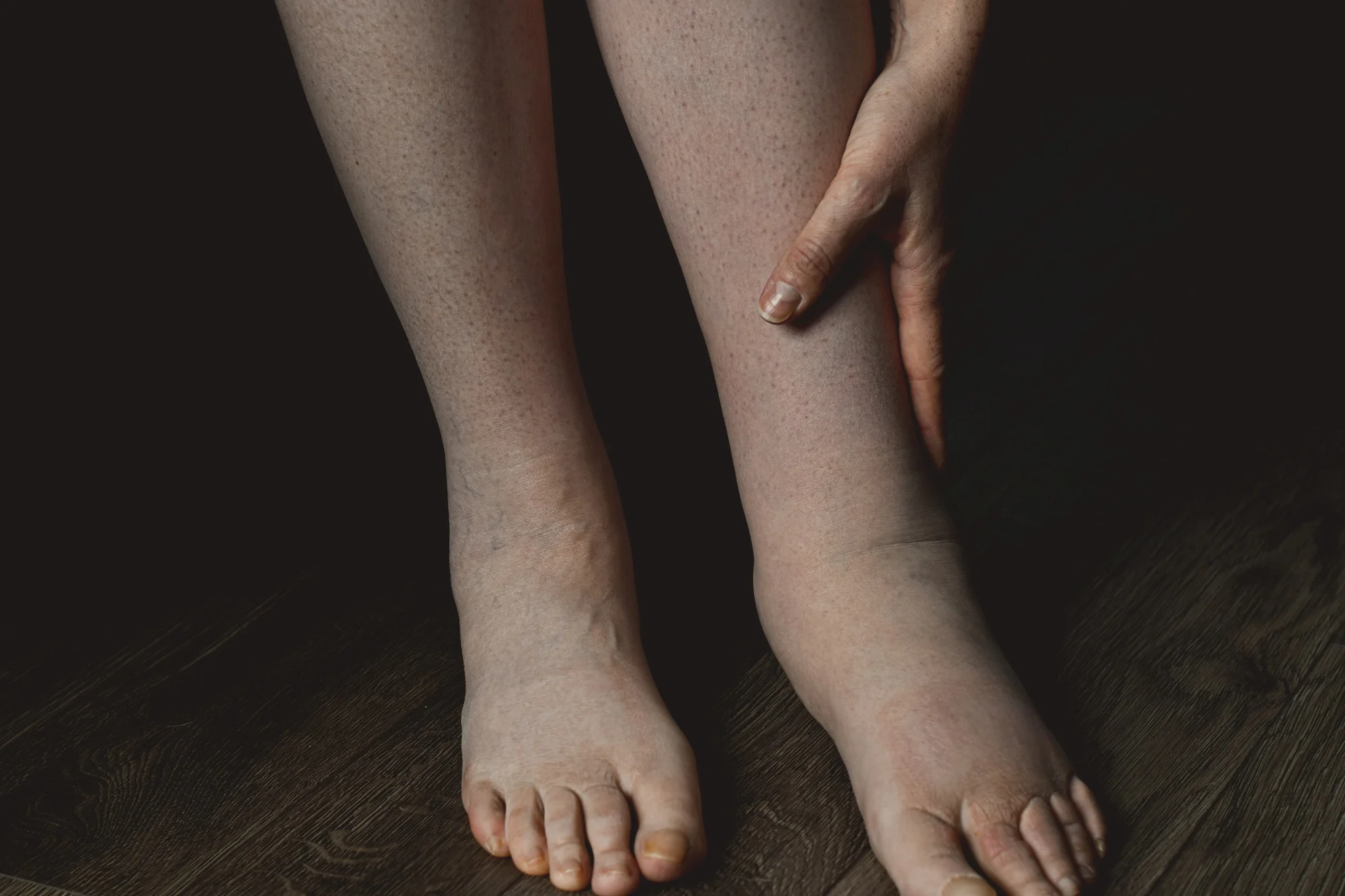 Why One Foot, Ankle, or Leg Might Be Swollen?