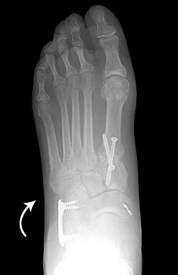 Understanding Flat Feet: Causes, Symptoms, and Treatment - After