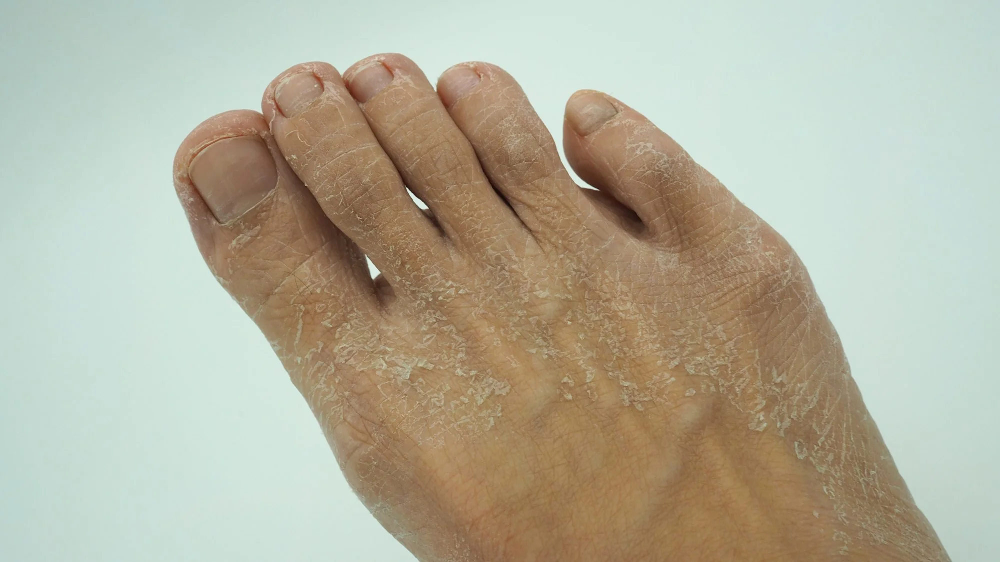 Foot skin is peeling with fungus