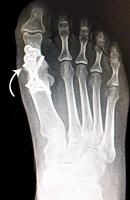 Great Toe Fusion after