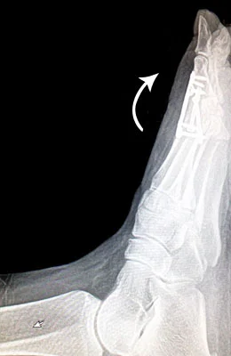 Lateral Fusion of the Great Toe after