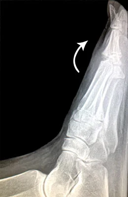 Lateral Fusion of the Great Toe before