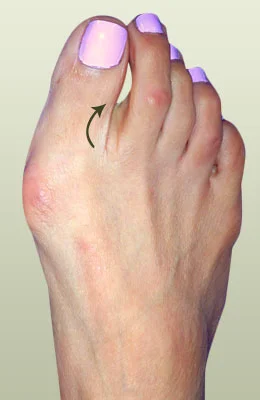 Correcting a Bunion through Surgery before