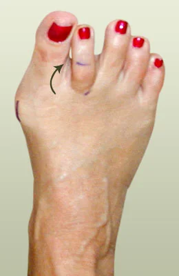 Bunion with Hammertoe Surgery before