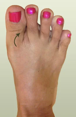 Hammertoe with Bunion before