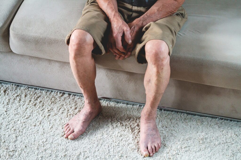 Peripheral Vascular Disease