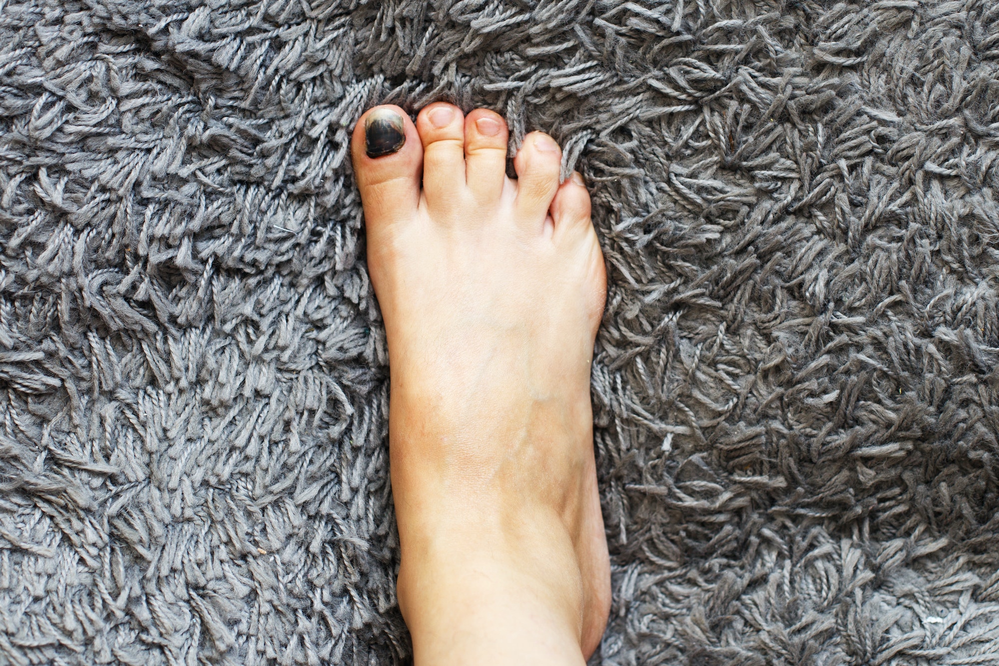 why-are-my-toenails-discolored